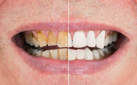 दांतों की गंदगी को साफ करने के लिए इस फल का ऐसे करें इस्तेमाल, मोतियों की तरह चमकने लगेंगे पीले दांत