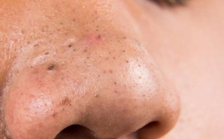 नाक पर नजर आने वाली कील यानी ब्लैकहेड्स से परेशान हैं, तो पानी में घोलकर लगा लें यह सफेद चीज