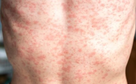 इस साल अब तक अमेरिका में खसरे के 900 से ज्यादा मामले, मौसमी इन्फ्लूएंजा वायरस से 216 की मौत : सीडीसी