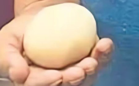 बुजुर्ग के पेट से निकला 200 ग्राम अंडे जैसा गोला, न ट्यूमर न पथरी… फिर क्या थी ये अजीबोगरीब चीज?